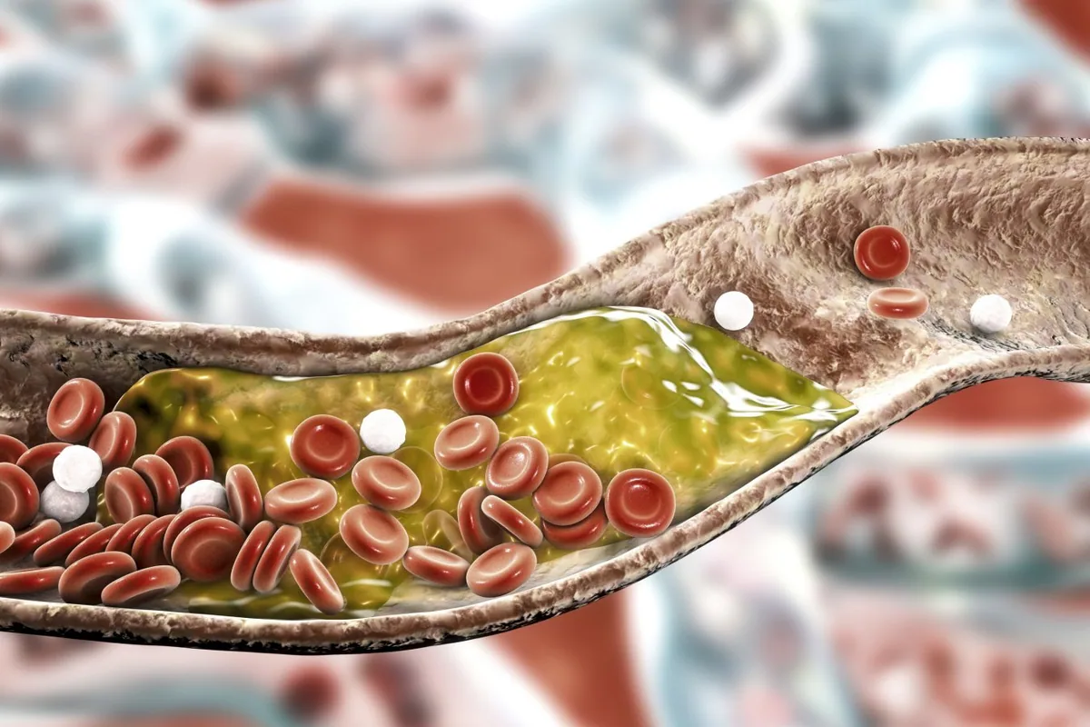 Young adults show signs of early arterial plaque buildup